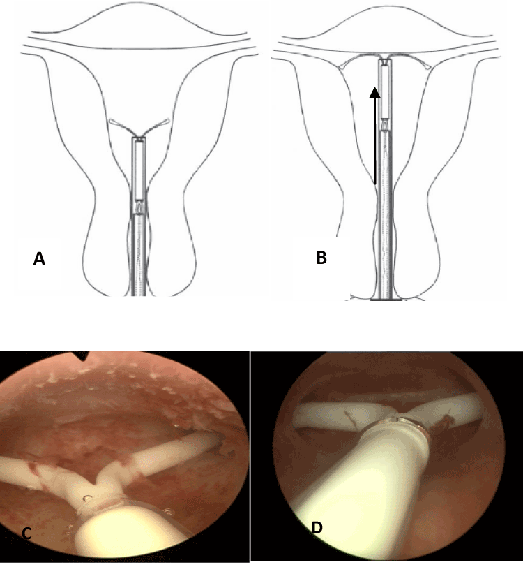 an IUD
